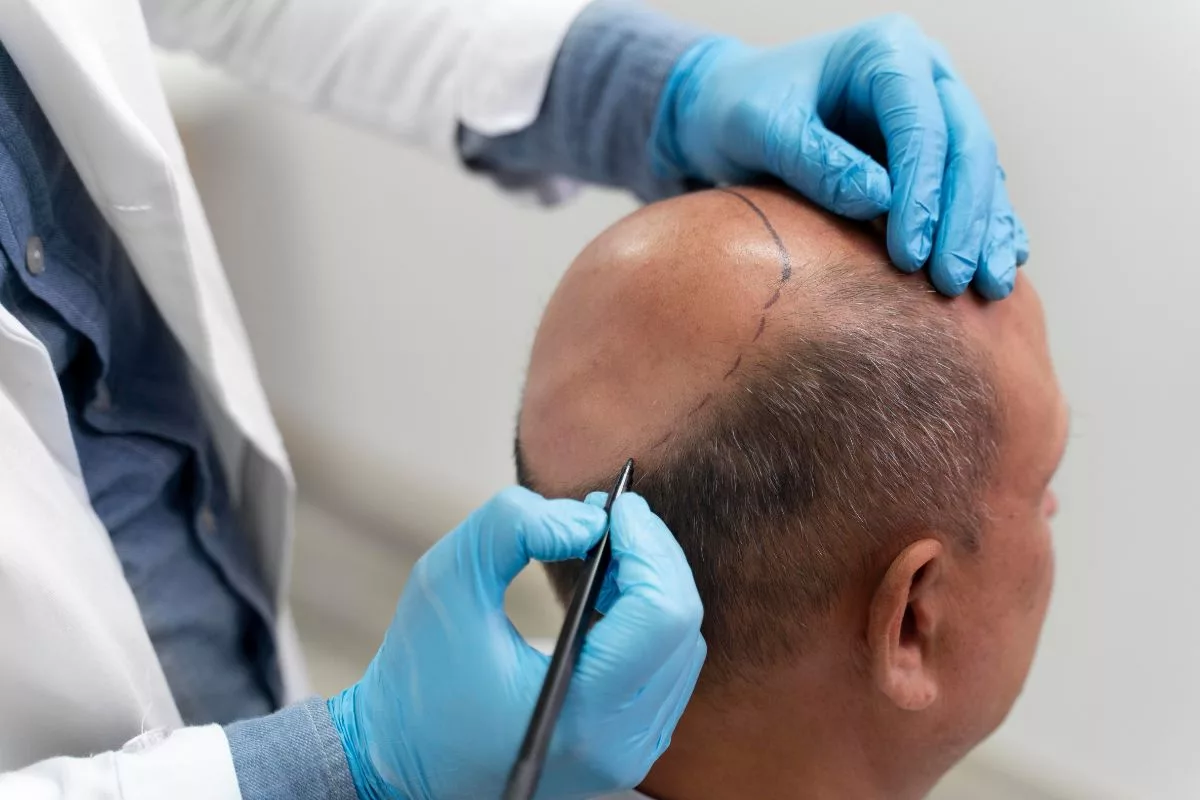 A prótese capilar é uma solução estética eficiente para recuperar volume e autoestima