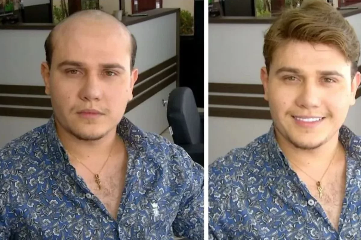 Prótese capilar é opção para homens que sofrem com calvície